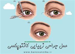 عمل جراحی زیبایی کانتوپکسی چشم